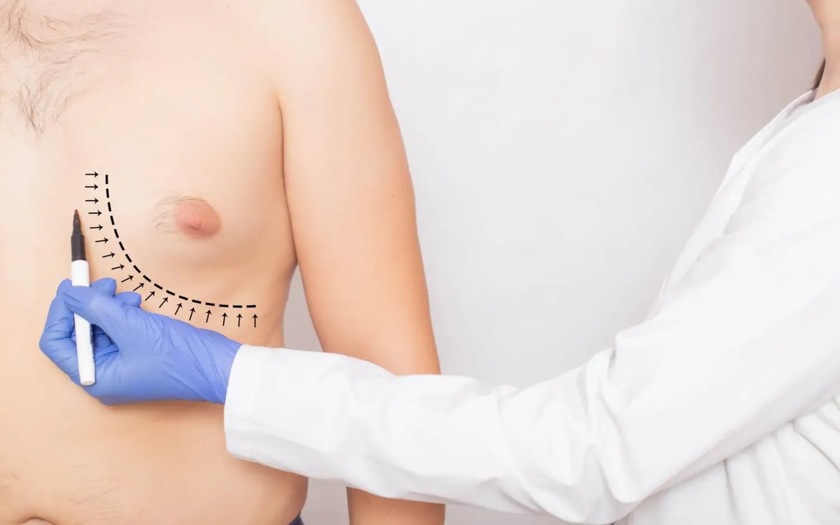 Gland, Fat or Both: How Surgeons Read an Enlarged Male Chest